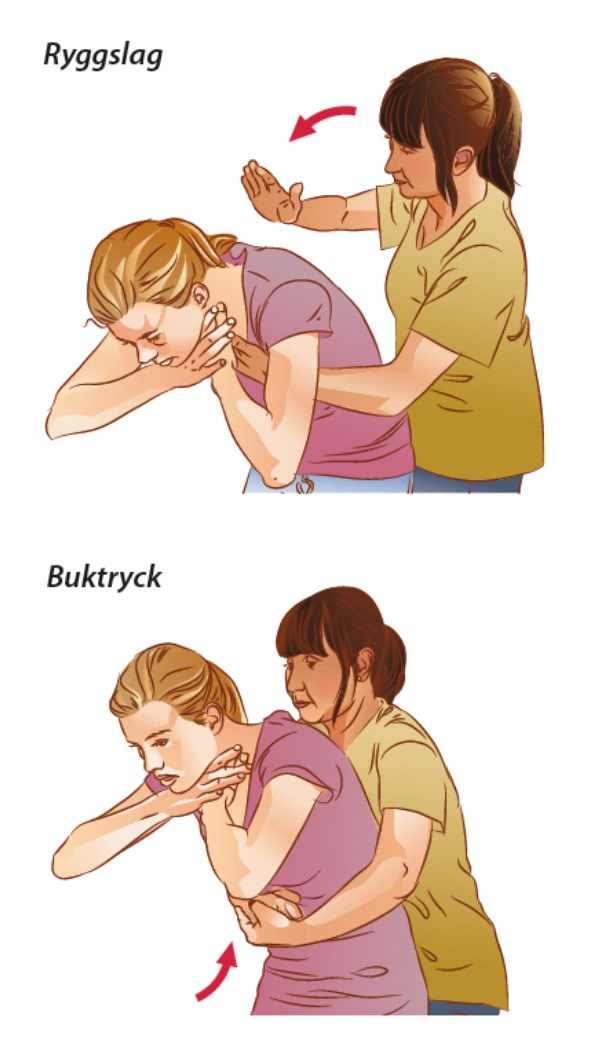 Illustration över hur man gör ryggdunk och buktryck.